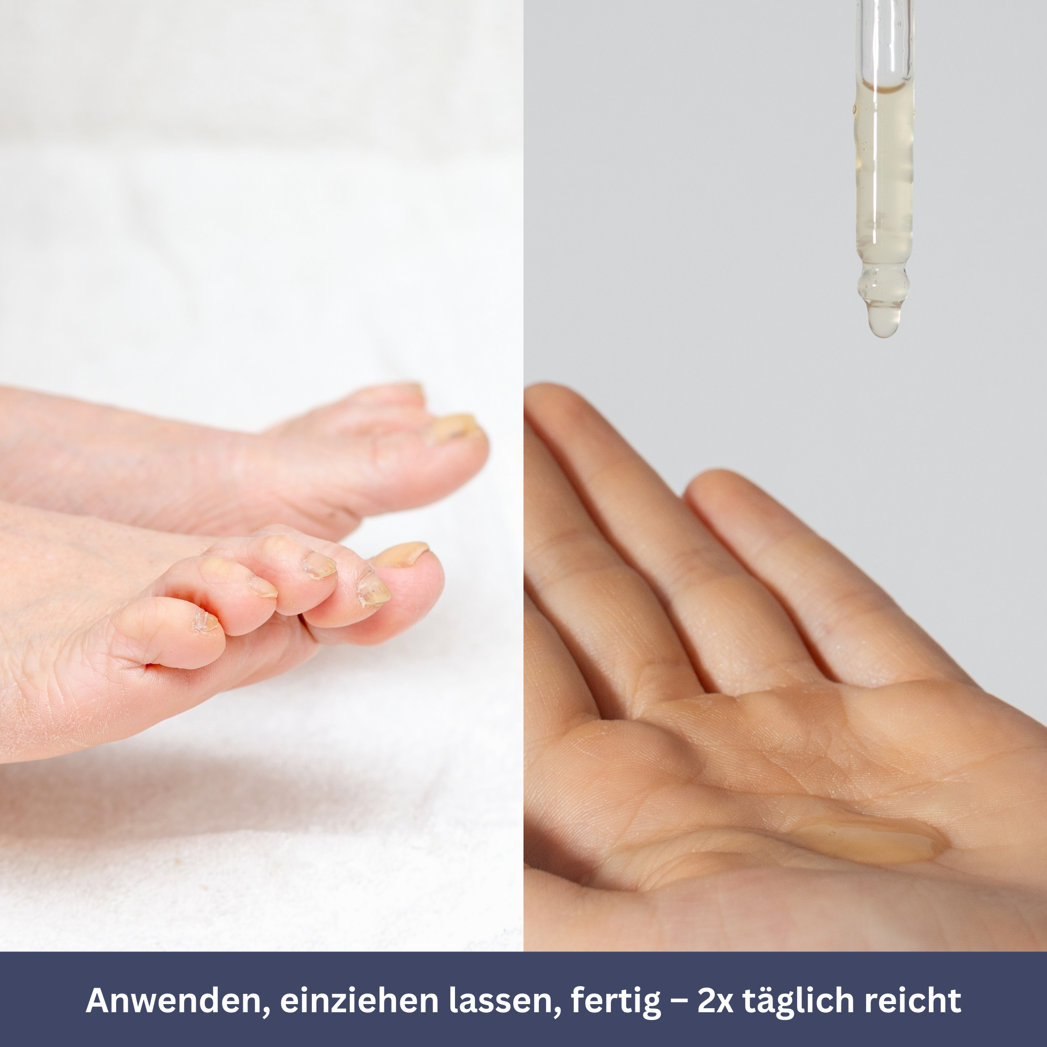 NailDrops – Care Serum for Nail Fungus
