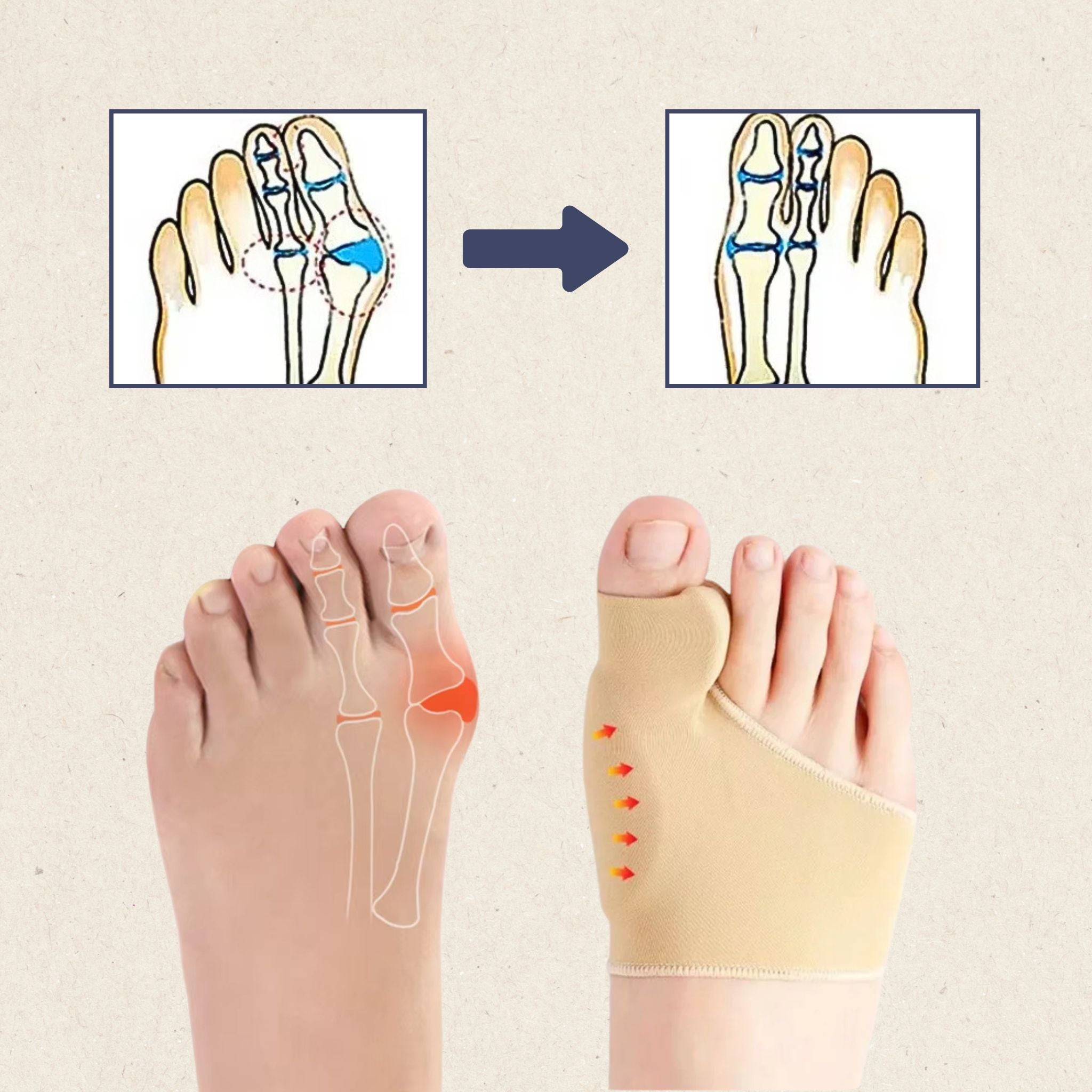 HalluxFit Bunion Corrector