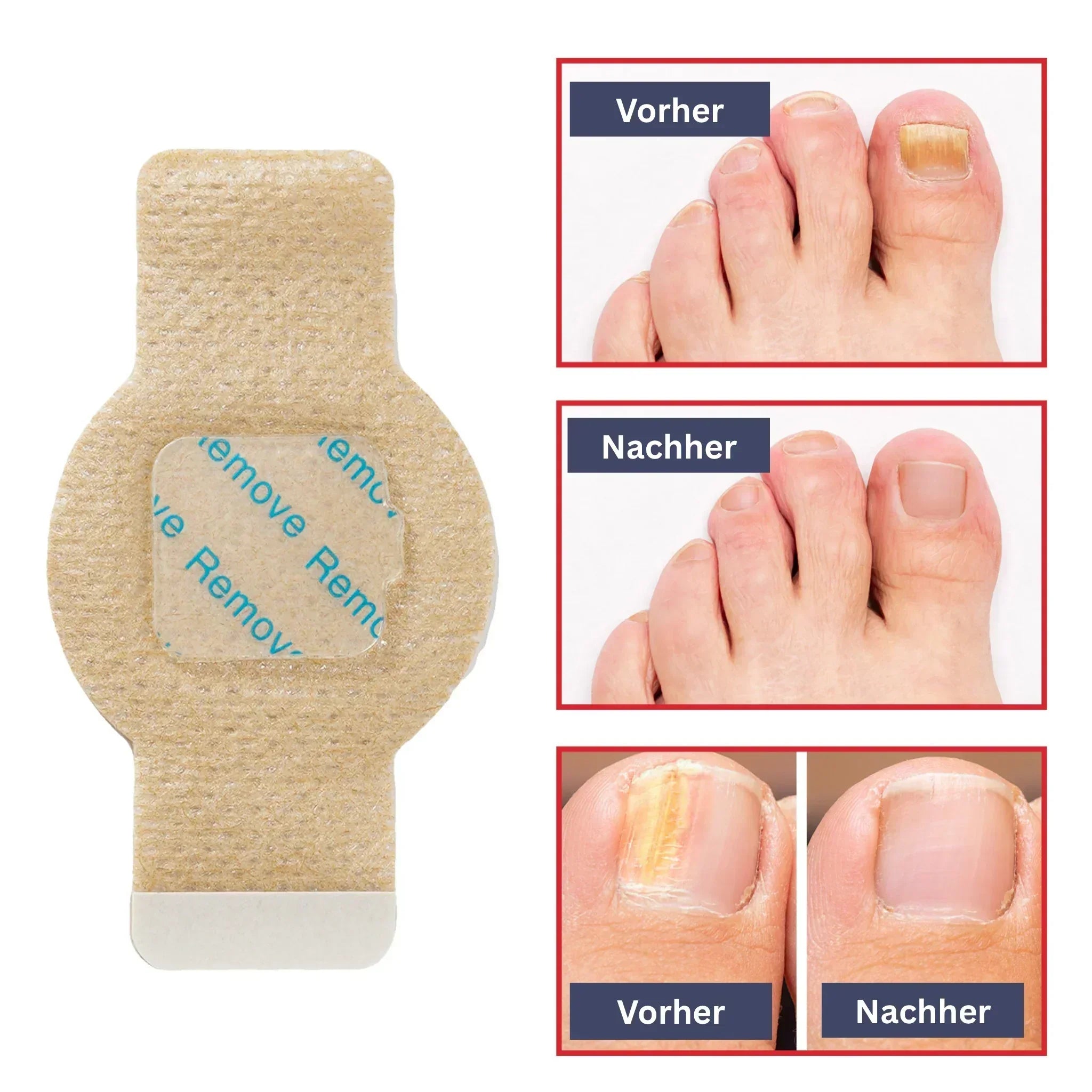 Nail Care Hydrogel Patches