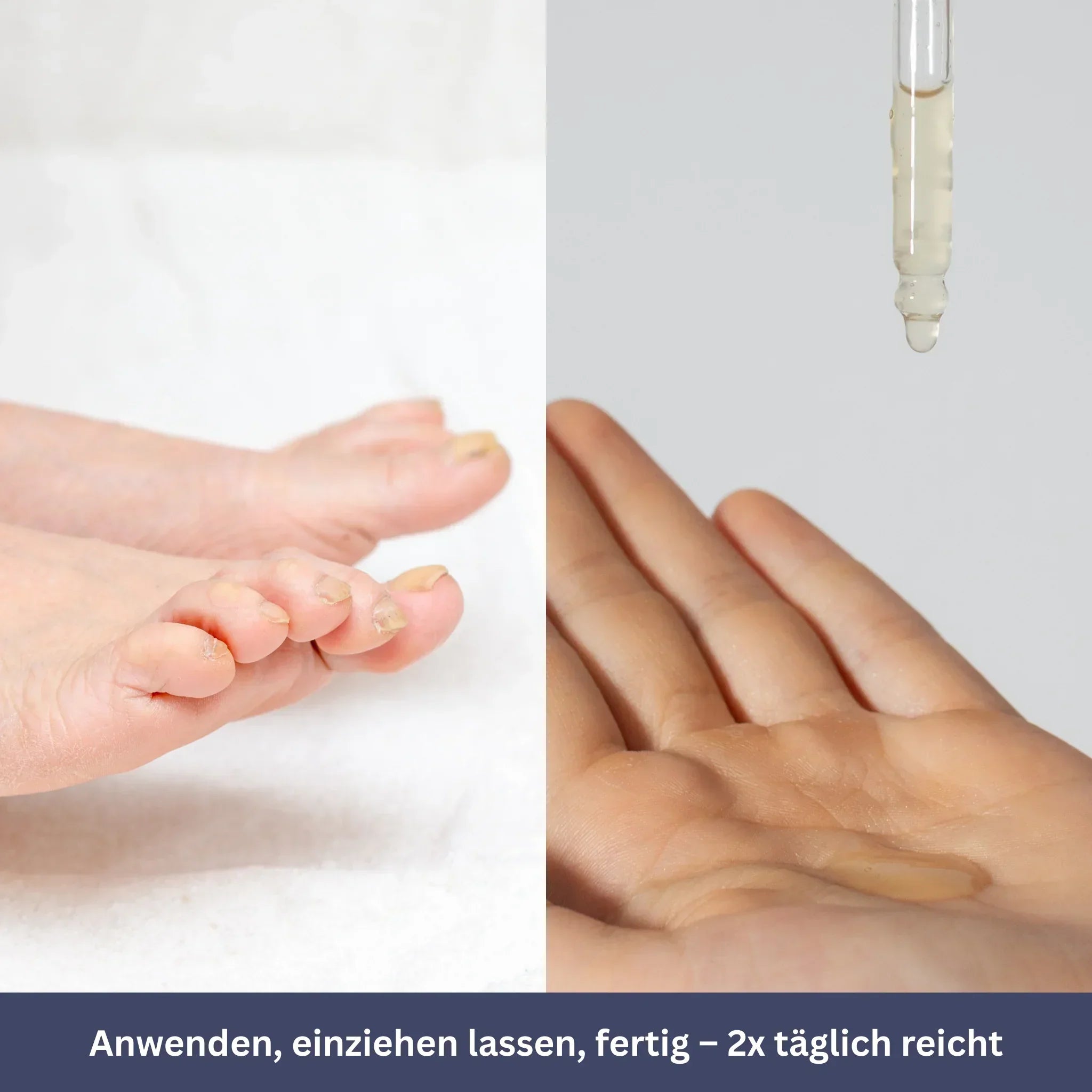 NailDrops – Care Serum for Nail Fungus